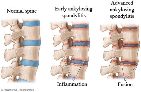 ankylosing spondylitis